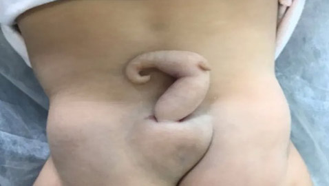 ظاهرة نادرة.. طفلة برازيلية ولدت بذيل طوله 6 سم! صور