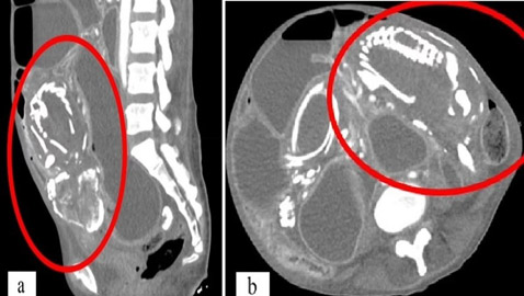 وفاة امرأة من سوء التغذية بسبب جنين غير مولود