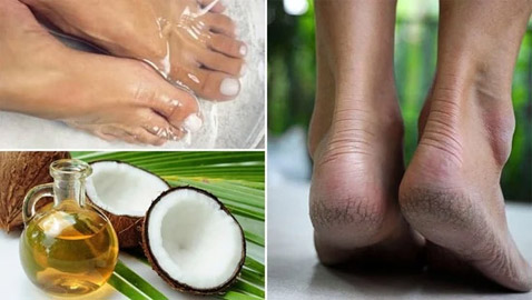 علاج تشقق القدمين في يومين فقط بالمكونات الطبيعية
