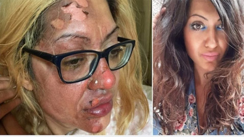 بيضة تشوه وجه امرأة بسبب حيلة على تيك توك