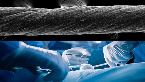 لتسريع الشفاء بعد الجراحة.. ابتكار خيوط قابلة للذوبان