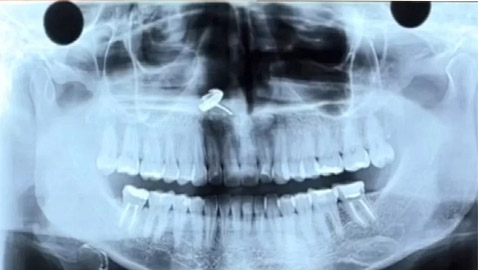 تكتشف وجود قرط عالق في أنفها منذ سنوات