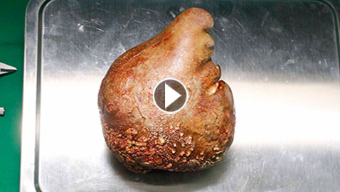 فيديو وصور: استئصال أكبر وأثقل حصوة كلوية في العالم