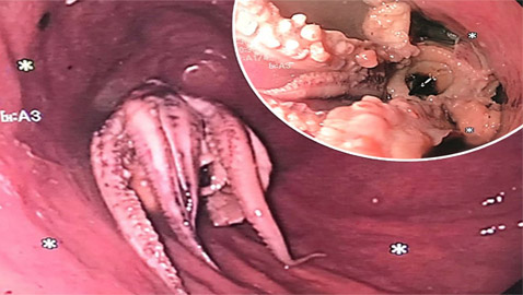 الأطباء ينقذون رجلا علق أخطبوط في حلقه!