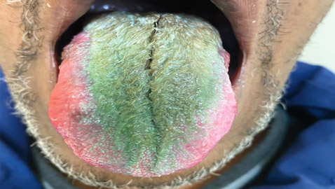 لسبب غريب.. لسان رجل أمريكي يتحول إلى 