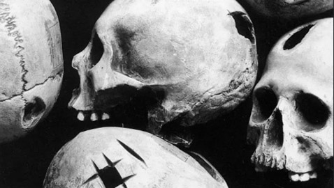 لماذا كان الإنسان القديم يثقب جمجمته؟