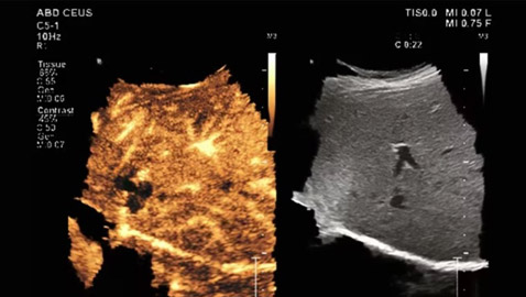 فيليبس تطلق تقنية جديدة لتشخيص السرطان بالموجات فوق الصوتية