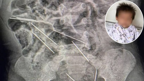 كيف فعلها؟ طفل يبتلع 8 إبر حقن والأطباء يتدخلون بـ