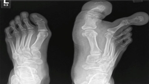 فتاة تعاني من حالة نادرة بالقدم تجعلها تكافح لارتداء حذاء.. وأطباء يكشفون أسبابها