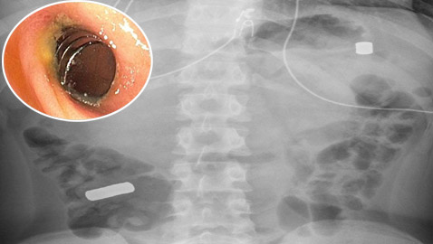 مراهق يبتلع 12 مغناطيسا ويُجبر على إجراء جراحة إسعافية.. صور
