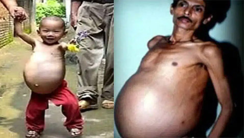 أغرب ما قد تسمعه على الإطلاق.. رجل هندي حامل لمدة 36 عاما!