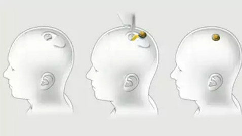 طوابير بالآلاف لتجربة شريحة إيلون ماسك للدماغ