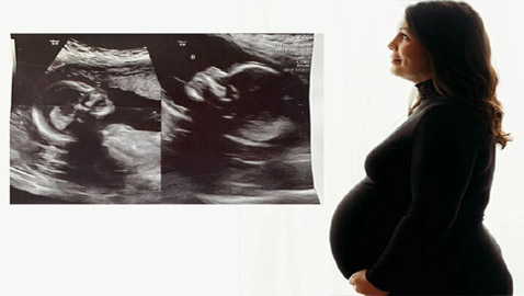 توأمان لأم واحدة.. ينمو كل منهما في رحم!