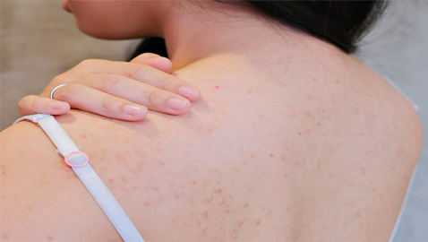 أسباب ظهور الحبوب في الظهر وأسرع علاجات للتخلص منها