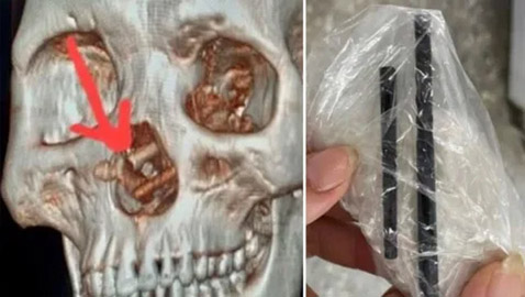 عيدان تناول طعام اخترقت أنف مريض لجمجمته وظلت 5 أشهر! صور