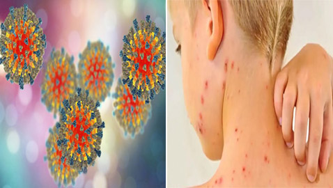 دولة أوروبية تعلن انتشار عدوى فيروسية شديدة تنتقل عبر الهواء!