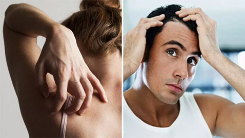 6 علامات تشير إلى وجود أمراض خطيرة وراء تساقط الشعر