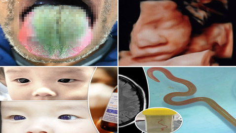 لسان بشعر وجنين داخل دماغ طفل.. أغرب الحالات الطبية في 2023