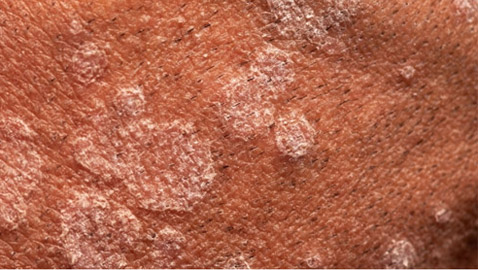 بعد وفاة جندي إسرائيلي بنوع مجهول منها التقطه في قطاع غزة.. أخطر 10 فطريات فتاكة مسببة للعدوى والموت