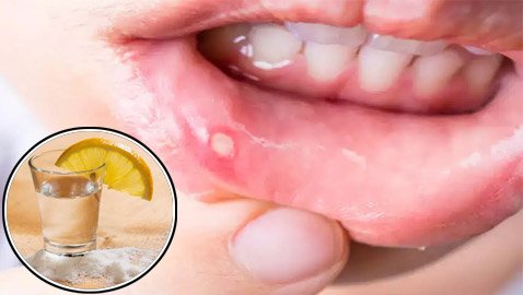 علاج تقرحات الفم في المنزل.. بطرق بسيطة وفعالة