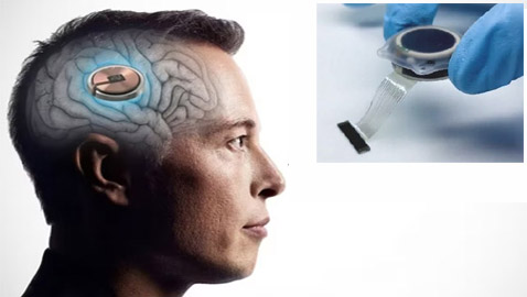 جديد شريحة ماسك المزروعة بالدماغ.. المريض حرك فأرة بمجرد التفكير