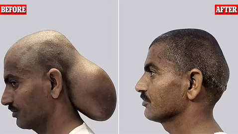 هندي عاش برأسين لمدة 15 عاما.. ما قصته؟