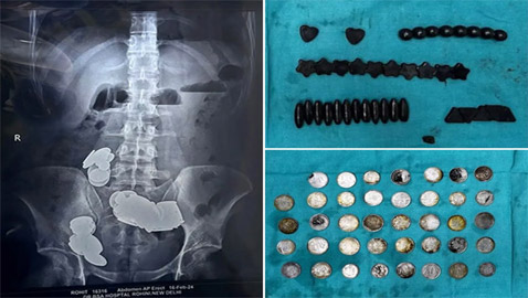 شاب يبتلع 37 مغناطيس و39 عملة معدنية ليبني عضلات! صور