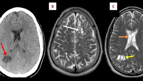 بيض ديدان شريطية بدماغ رجل أمريكي.. والسبب لا يصدق!
