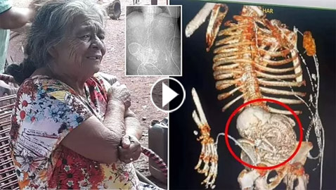 وفاة سيدة بعد عملية استئصال جنين متحجر حملته بأحشائها لأكثر من 50 سنة!