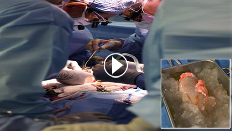 فيديو: جراحون أمريكيون يزرعون كلية خنزير معدل وراثيا لمريض حي