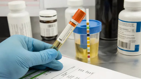 7 طرق لخفض حمض اليوريك في الجسم.. تعرف إليها