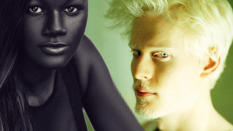 6 اشخاص جذبوا انتباه العالم بلون البشرة غير المألوف