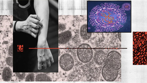 خطر وبائي.. اكتشاف سلالة متحورة من فيروس جدري القرود!