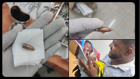 في وقت واحد.. توليد سودانية واستخراج رصاصة من رأسها