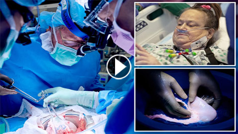 نجاح ثاني عملية زرع كلية خنزير معدلة في شخص يناهز 54 عاما (فيديو وصور)