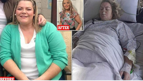 عملية فاشلة للتخلص من الوزن في تركيا تحرم أيرلندية من طحالها