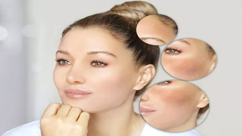 حيل للتخلص من البقع الصبغية على الوجه تغنيكم عن العلاجات التجميلية