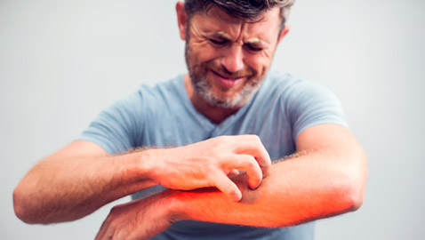 7 علاجات منزلية تخفف الحكة والتهاب الجلد في الصيف