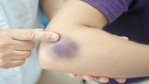 أسباب ظهور البقع الزرقاء على الجلد ومتى تكون خطيرة