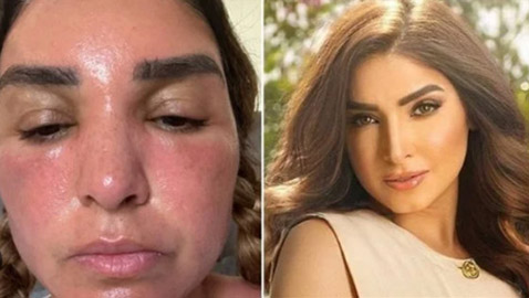 صور صادمة للفنانة روجينا: تضخم بالوجه وحروق! ونصائح لحماية البشرة من حروق الشمس!