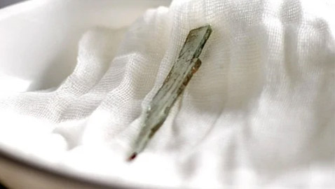 قصة رجل روسي عاش بشظية زجاجية في كبده 9 سنوات (صور)