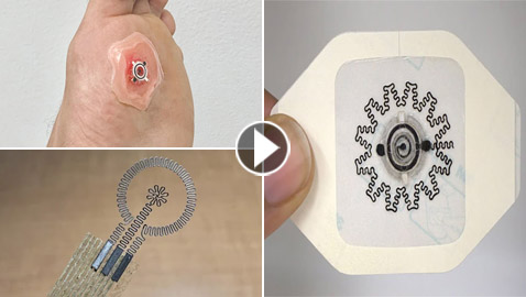 لعلاج الجروح بطيئة الالتئام.. ابتكار ضمادة كهربائية تعمل بالماء (فيديو)