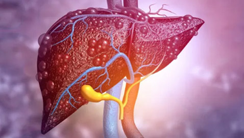 5 علامات تظهر فى الجسم عند الإصابة بعدوى فى الكبد