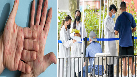 يثير مخاوف عالمية.. نيويورك تؤكد أول إصابة بجدري القردة