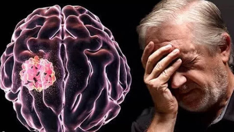 مش بس الصداع.. 4 علامات تحذيرية مبكرة لأورام المخ لا تتجاهلها