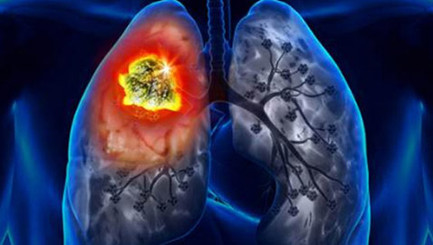 أعراض خفية لسرطان الرئة تظهر على الكتفين والرقبة