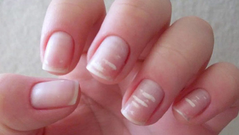 أبرز 8 مشكلات تظهر على الأظافر.. لا تتجاهلوها أبدا