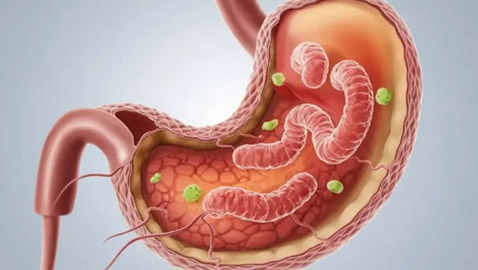  أطعمة تساعد في علاج جرثومة المعدة.. والثوم على رأس القائمة